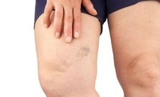 Kapalı Varis Ameliyatı Nasıl Yapılır?